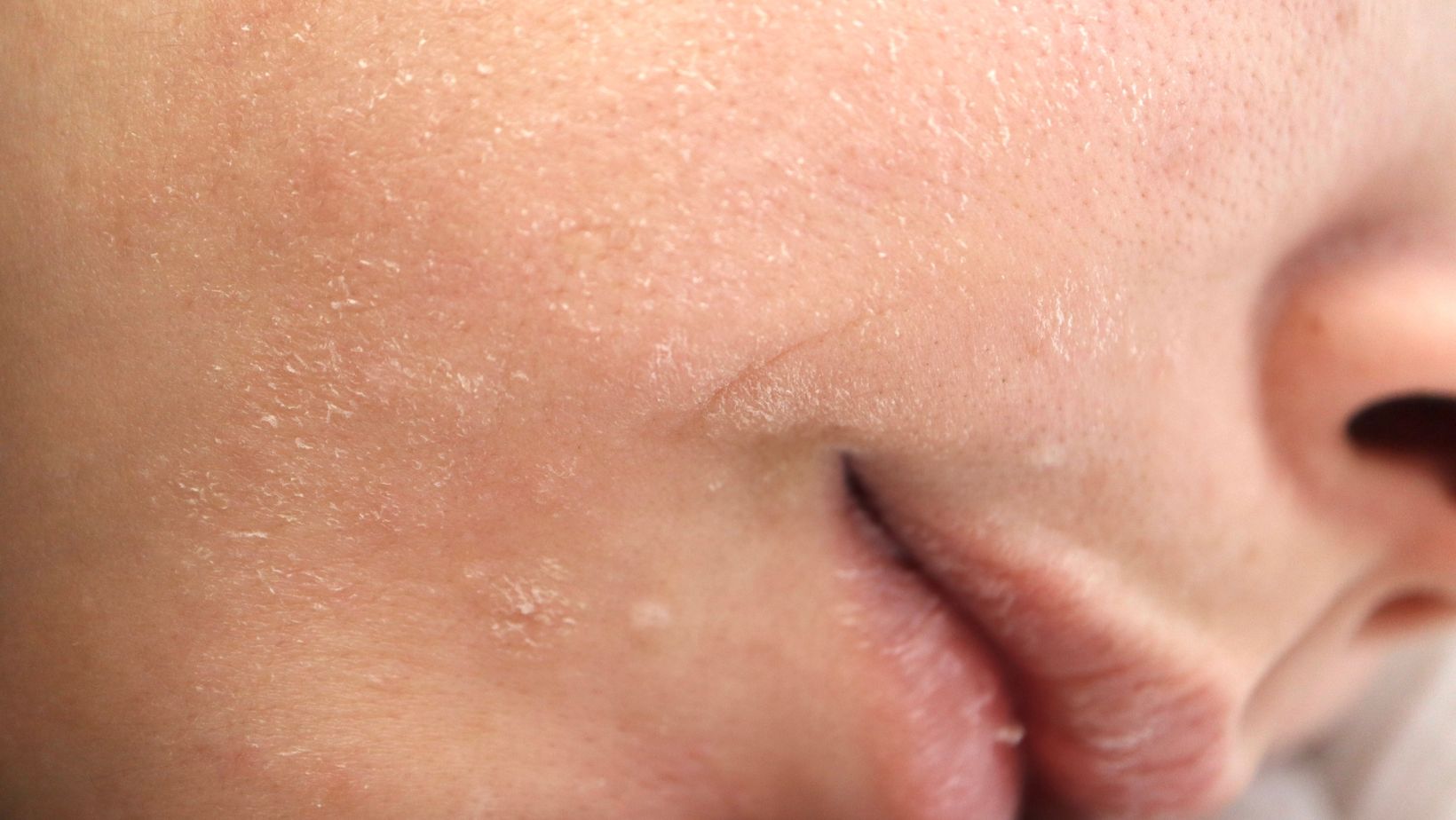 Suchá a šupinatá pokožka – obnova a kompletný návod, ako ju dať do poriadku, prirodna kozmetika zo slovenska, obnova koznej bariery